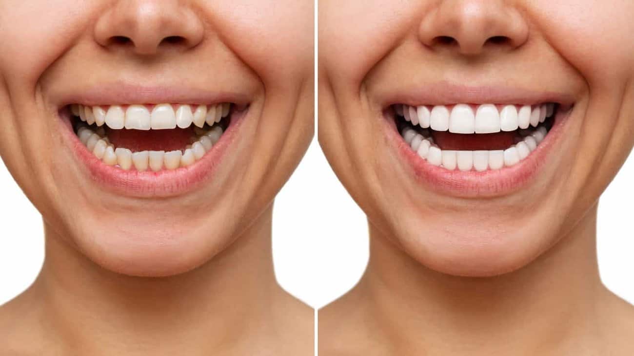 Contact Aspire White for teeth whitening services – Get in touch with Dagenham today