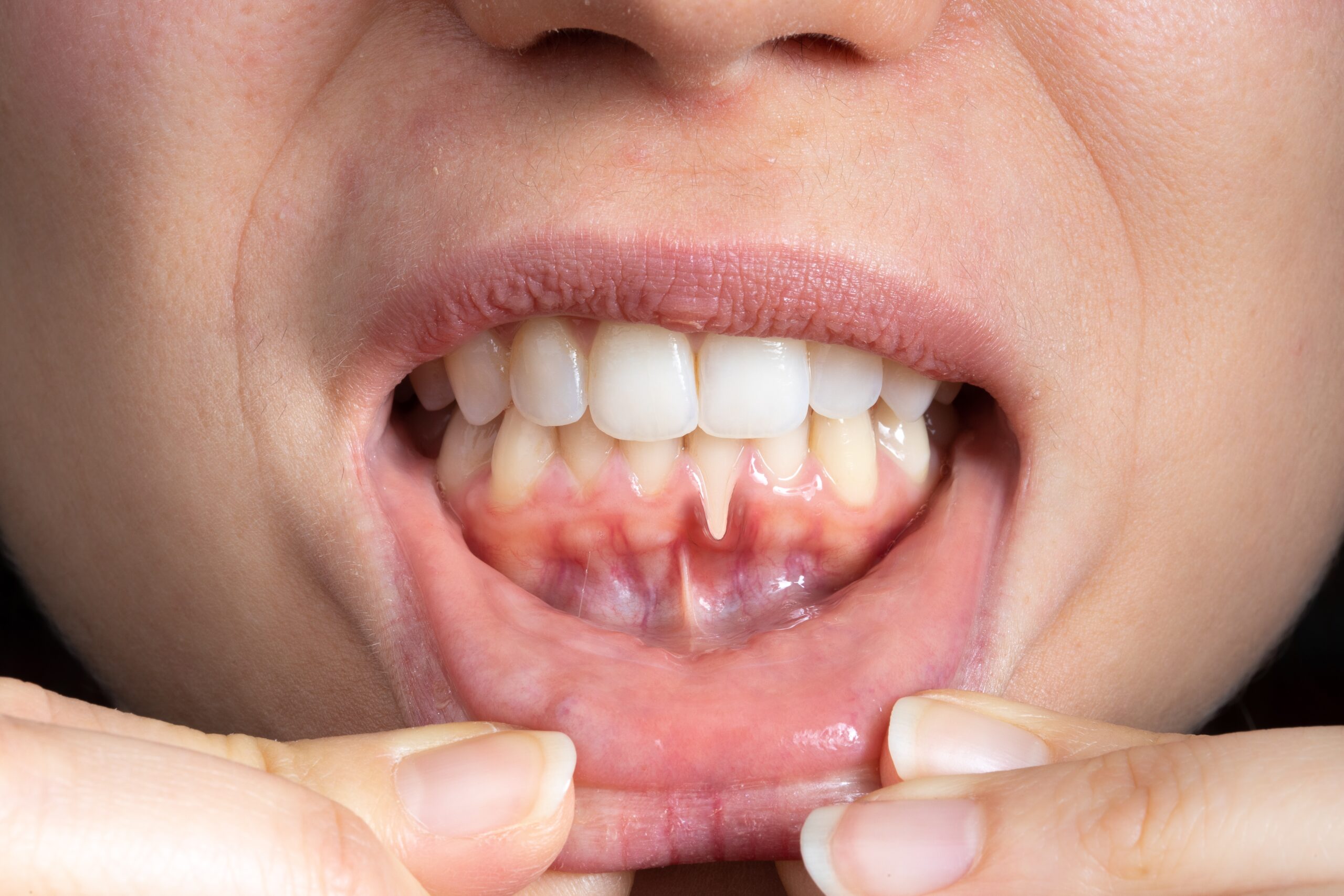 Could Investing in Gum Health First Lead to Longer-Lasting Whitening Results Dagenham