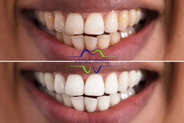 Aspire White customer before and after Dagenham results.