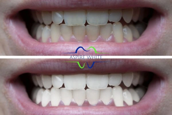 1 hour laser teeth whitening before and after results Dagenham