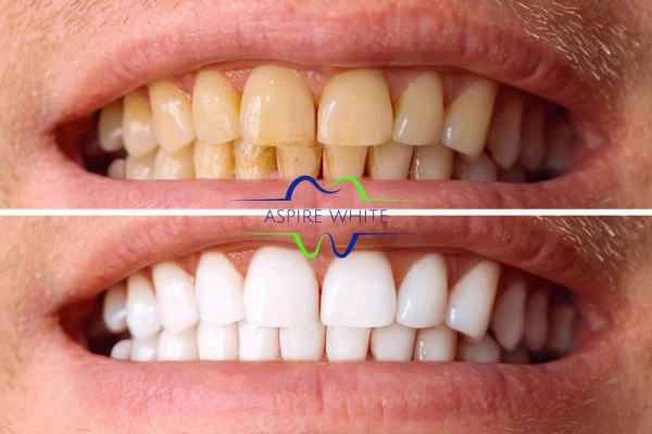 Get noticeable whiter smile in just one hour! Book your teeth whitening treatment Dagenham today!