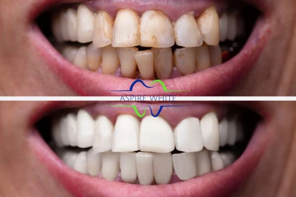 Before and after results of laser teeth whitening Dagenham Book in online today!